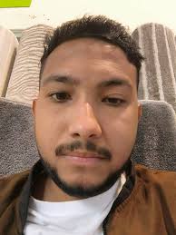 Wonky Eyes and Facial Asymmetry