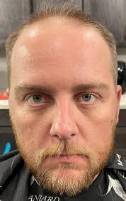 Best Doctors in the US : r/HairTransplants