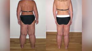 Oder bin ich einfach nur zu dick?: Lipödem belastet Influencerin