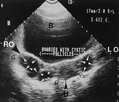 The most sensitive sign for a pericardial effusion on cxr is enlargement of the cardiac silhouette. Diagnostic Ultrasonography In Gynecology Glowm