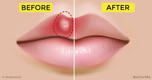 What causes pimples on the lip line? 3 Ways To Treat Pimple On Lip Fast