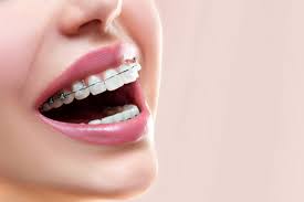 Maybe you would like to learn more about one of these? 5 Jenis Kawat Gigi Behel Yang Bisa Anda Pilih Hello Sehat