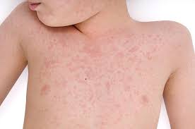 Maybe you would like to learn more about one of these? Demam Campak Measles Punca Simptom Dan Rawatan The Diagnosa