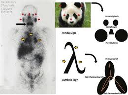 Its namesake, the greek letter lambda (λ), is used in lambda expressions and lambda terms to denote binding a variable in a function. Lambda Panda Sign Sarcoidosis Panda Radiology Sonography