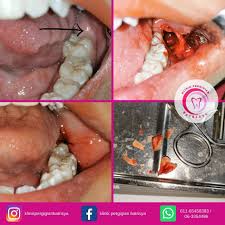 Pengalaman aku cabut gigi garham bongsu.sakit nak mampos masa cabut.walaupun dah dibius. Gigi Bongsu Kerap Sakit Je Klinik Pergigian Batrisya Facebook