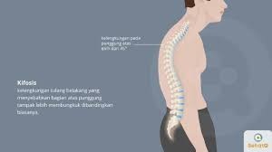 Sehingga salah satu bahu tampak lebih rendah dari bahu lainnya. Kifosis Tribunnewswiki Com Mobile