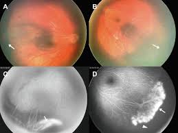 Ear diseases, eye diseases, fetal diseases, genetic diseases, neuronal diseases, rare diseases. Familial Exudative Vitreoretinopathy And Norrie Disease Sciencedirect