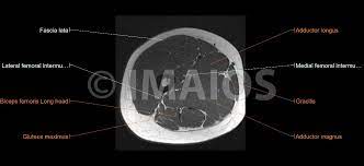 (2a) on the sagittal t2 weighted image through the lateral aspect of the thigh, interstitial edema is seen within the long head of the biceps femoris muscle. Lower Extremity Mri Anatomical Atlas