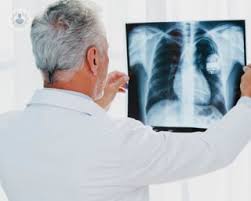 ( mesothelioma o mesothelioma) como se contrae, sintomas, sus fases y medidas para poder enfrentarlo. Mesotelioma Pleural Que Es Sintomas Y Tratamiento Top Doctors