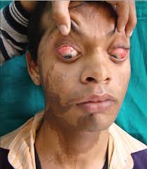 Image result for nevus sclerae