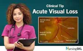 Image result for Acute Vision Loss