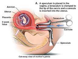 The rest who aborted did so at some point during the following two weeks. The Case Against Abortion Abortion Procedures