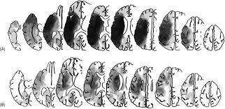 Finds the midpoint of a line segmrnt. The Character Line Bisection Task A New Test For Hemispatial Neglect Sciencedirect