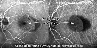 Liste(s) de symptome(s) à titre informatif uniquement, vous ne pouvez pas et ne devez pas établir un diagnostic avec ces informations. Diagnostic Et Traitement De La Degerescence De La Macula Dmla