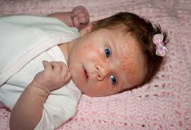 When skin allergy occurs in children 2 years of age or older, the child often has a rash on the crease of the elbow or knee. 8 Effective Home Remedies For Treating Baby Rash On Face