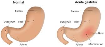The inflammation of gastritis is most often the result of infection with the same bacterium. Acute Gastritis Causes Symptoms Diagnosis Treatment Prognosis