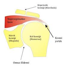 Ortopedi Ve Travmatoloji Ankara Omuz Kas Yirtiklarinda Artroskopik Tedavi
