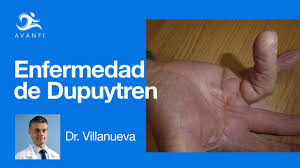 Afecta a hombres entre los 40 y los 60 años de edad y mayores. Enfermedad De Dupuytren Youtube