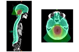 The causes of most childhood cancers are not known. Mxizk1potbu2om