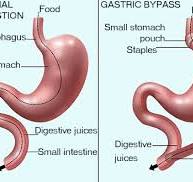 Gastric bypass surgery | healthdirect