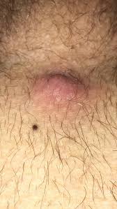 If you're really invested in pubic hair removal and want to minimize the chances of those dastardly ingrown hairs, the video suggests trimming your hair first. Nsfw This Ingrown Hair In My Pubic Area Popping