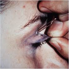 1second eyelid flip by a 3 year old girl. Examining The Eyes