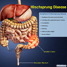 Hirschsprung Disease