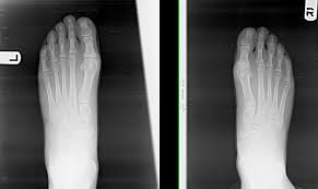 A wide foot suggests your feet are firmly planted on the ground. So That S What The Bones In My Feet Look Like Prairie Path Foot Ankle Clinic