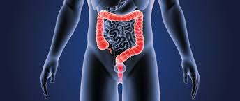See all parts of this guide hide guide parts. Colorectal Cancer Wcrf International