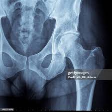 Image result for Hip XRay