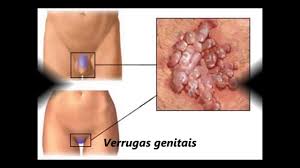 Verrugas Virais ➡️ Fotos, Imagens, Vídeos e Tratamento ⚜️