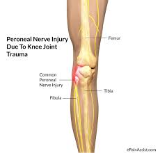 Pin On Knee Dislocation