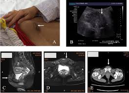The amount of pigment in the implant appears to increase with the age of the lesion. Multidisciplinary Treatment Of Abdominal Wall Endometriosis A Case Report And Literature Review European Journal Of Obstetrics And Gynecology And Reproductive Biology