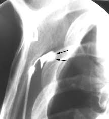 Image result for Scapulothoracic Injection