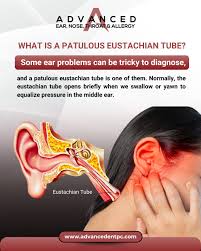 Image result for Eustachian Tube Dysfunction