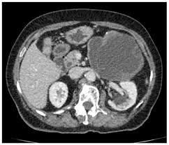 Percutaneous or surgical treatment can be applied according to their anatomic location and types. Medicina Free Full Text Pancreatic Hydatid Cyst Misdiagnosed As Mucinous Cystadenoma Ct And Mri Findings Html
