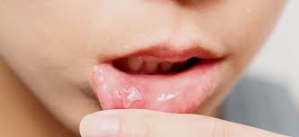 Image result for mouth ulcer on tongue)