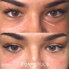 Dark Circles Treatment in Lahore | Best ...