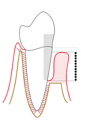 Periodontal Probe Wikipedia