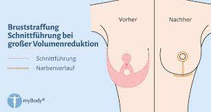 Für die geburtsjahrgänge ab 1964 gilt erstmals die rente mit vollendung des 67. Bruststraffung Fakten Kosten Arzte Und Kliniken Alle Informationen Zum Brust Straffen Mastopexie Auf Mybody De