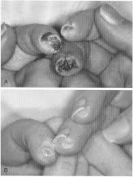 We did not find results for: Leg Ulcer Diagnosis And Management Dermatologic Clinics