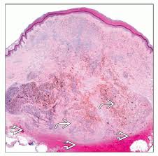 Image result for Blue Nevus