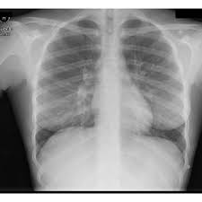 Contrast CT scan of the neck showing a thrombus in the left jugular...
