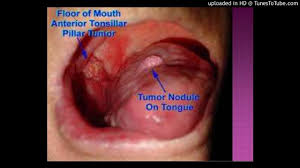 Image result for spinocellular carcinoma of the oral cavity