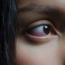 How to solve coronavirus, loadshedding and unemployment in one go. Ocular Rosacea The Real Reason For Your Bloodshot Eyes Allure
