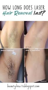 How does laser hair removal work? How Long Does Laser Hair Removal Last Laser Hair Removal Laser Hair Laser Hair Reduction