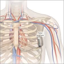 Image result for Internal Cardiac Defibrillator