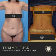 When Can You Have A Tummy Tuck After C Section Pin On Abdominoplasty Or Tummy Tuck