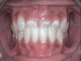 Anterior crossbite correction can involve braces and jaw surgery and anterior crossbite treatment in children is the same as for adults. Anterior Crossbite Angel Orthodontics