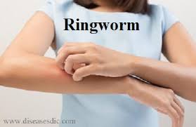 Gently dab the ringworm area with the solution 3. Ringworm Or Dermatophytosis Description Symptoms And Treatment
